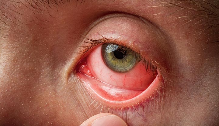 conjunctivitis